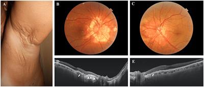 From Clinical Diagnosis to the Discovery of Multigene Rare Sequence Variants in Pseudoxanthoma elasticum: A Case Report